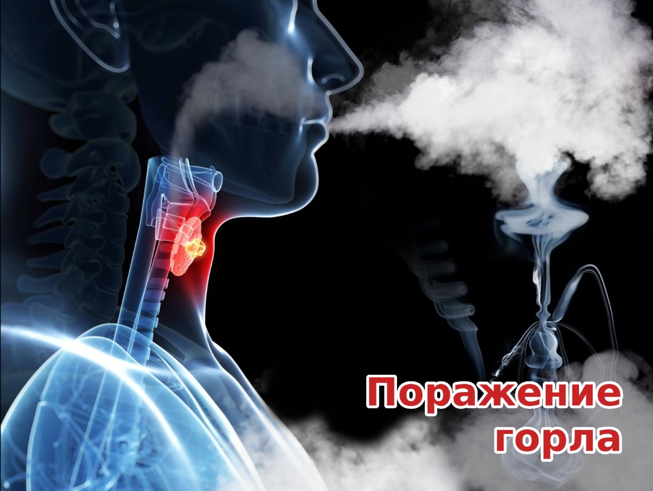 Поражение горла — НЦОЗ